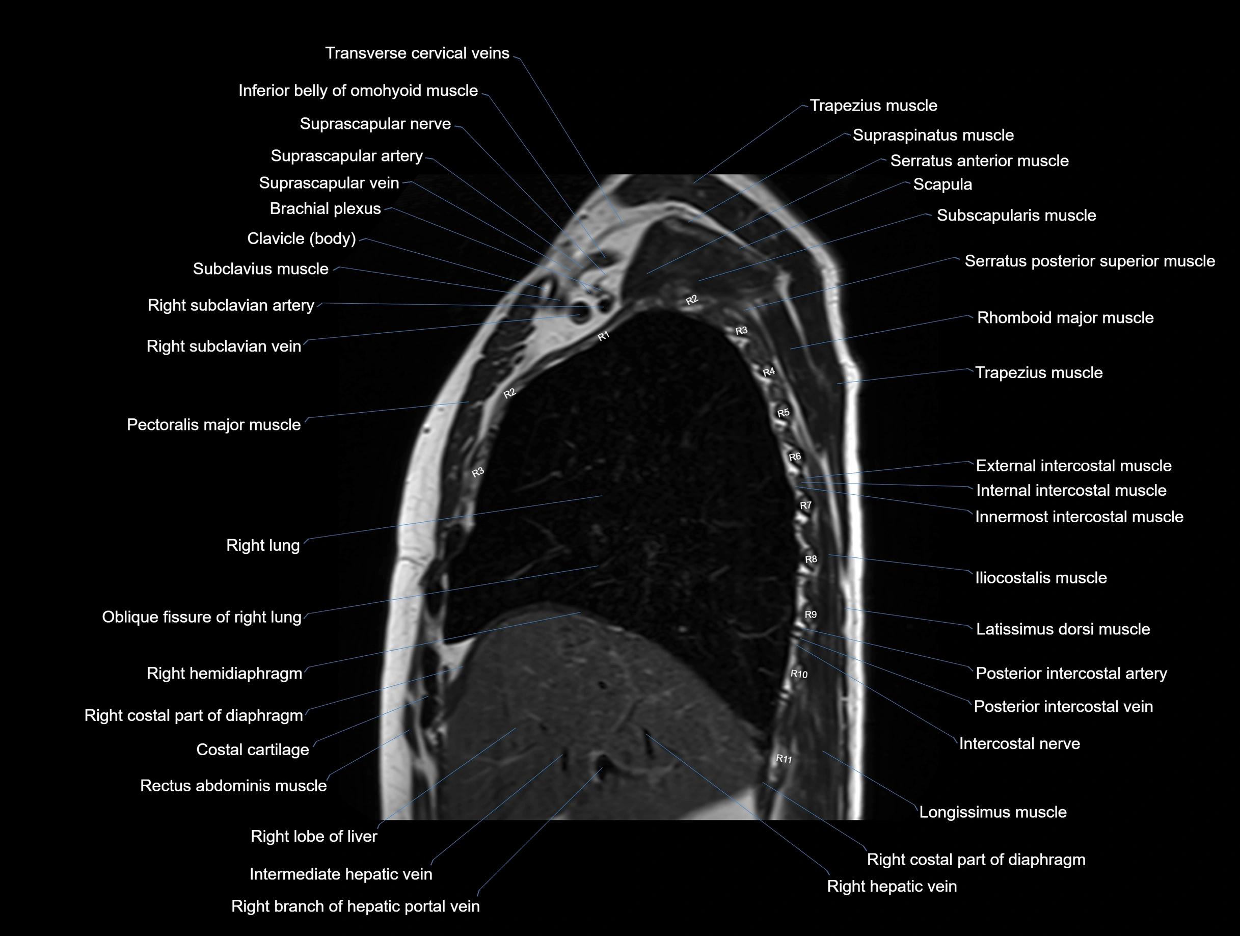MRI chest (thorax) coronal  cross sectional anatomy 3T radiology  image-img-00001-00012.webp
